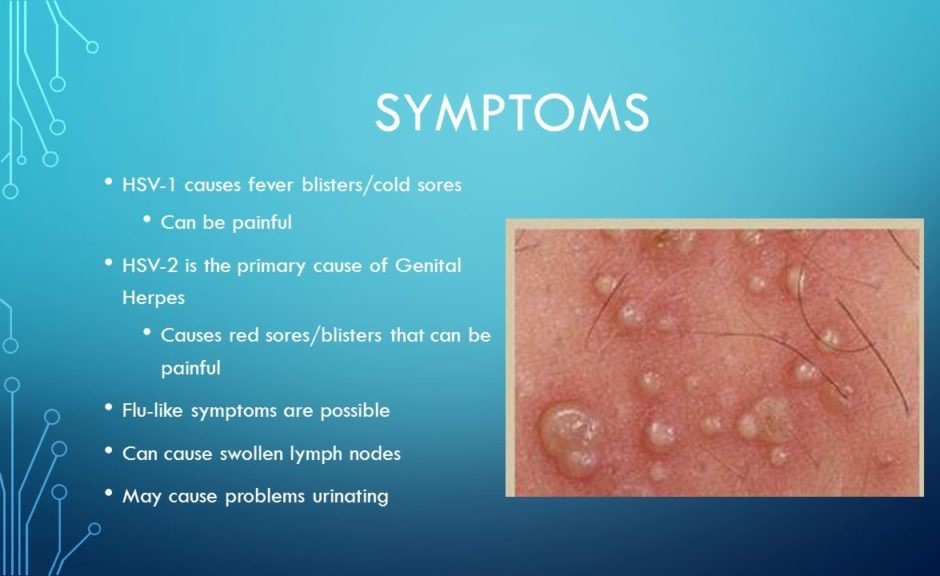 Various Facts About Genital Herpes | Biophytopharm