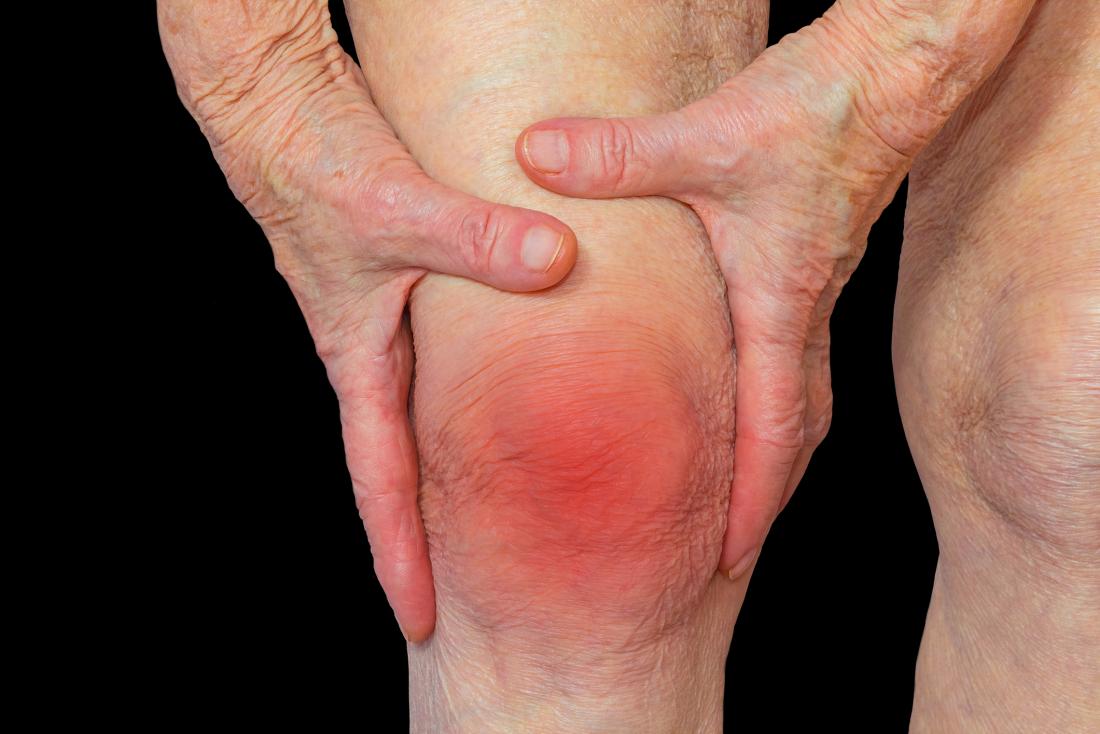 Rheumatoid arthritis (RA): Symptoms, causes, and complications