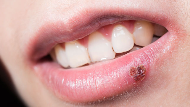 Cold Sores: Symptoms, Causes, Treatment, and More